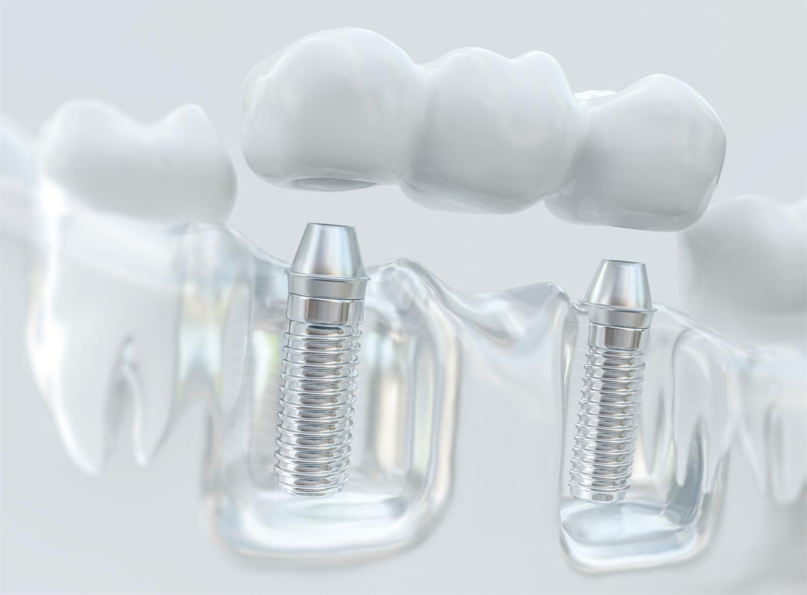 ¿De qué depende el éxito de los implantes dentales? - Imagen 1