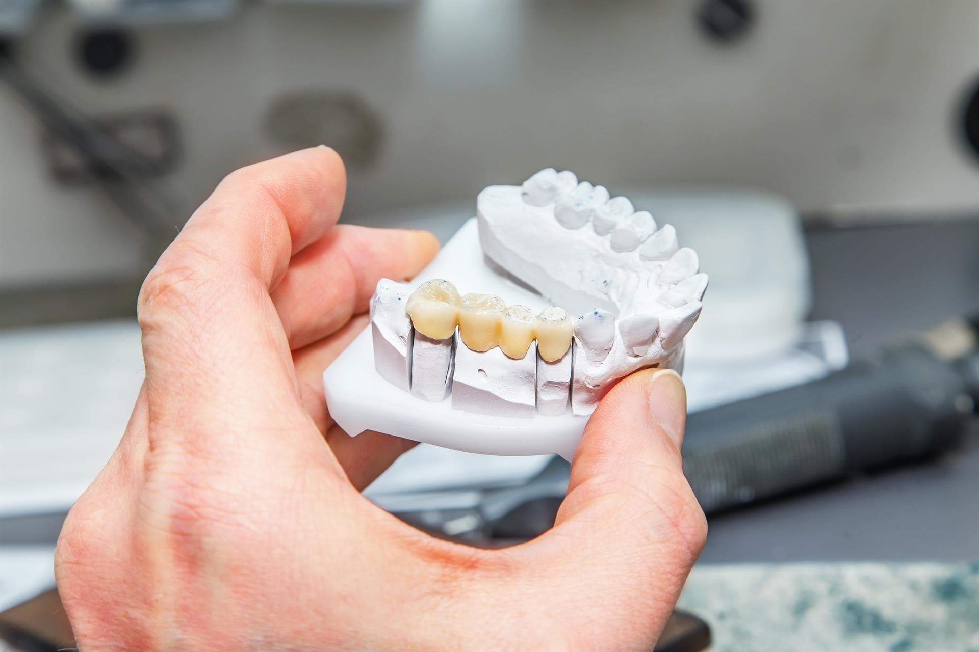 ¿Cuándo son necesarias las prótesis dentales?