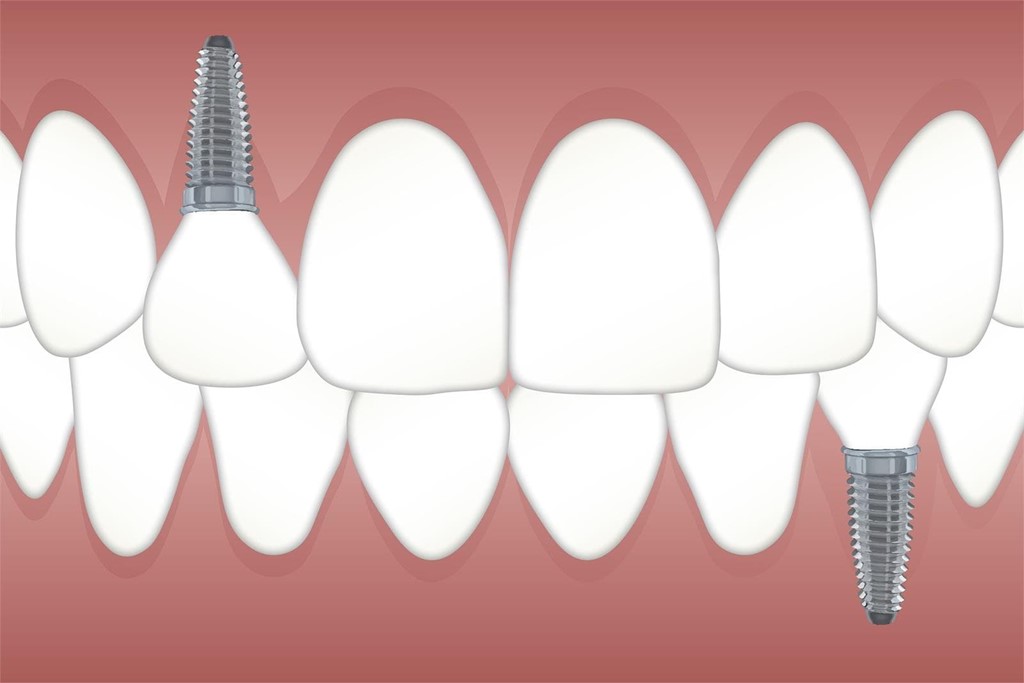 5 ventajas de colocar un implante dental