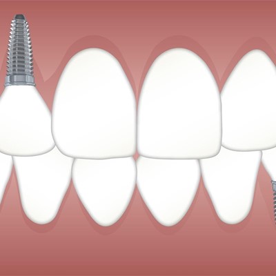 5 ventajas de colocar un implante dental