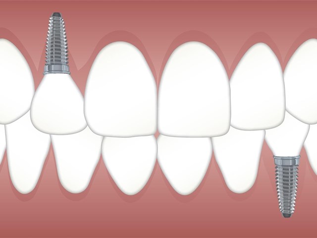 5 ventajas de colocar un implante dental