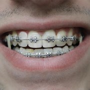 ¿A qué edad puedo empezar mi tratamiento de ortodoncia? 