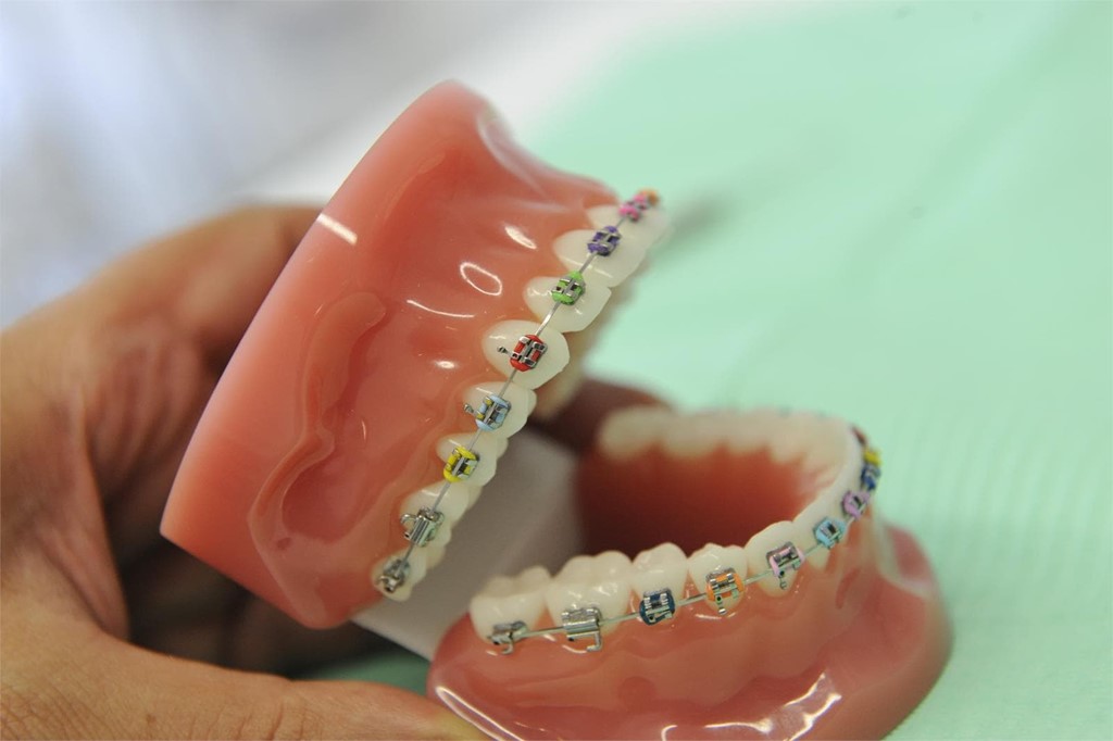 Aprende a usar la cera para brackets y olvídate de tus molestias