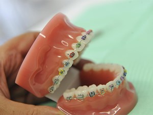 Aprende a usar la cera para brackets y olvídate de tus molestias