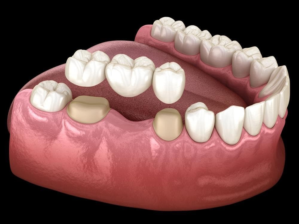 Cómo adaptarse a las prótesis dentales y evitar las molestias