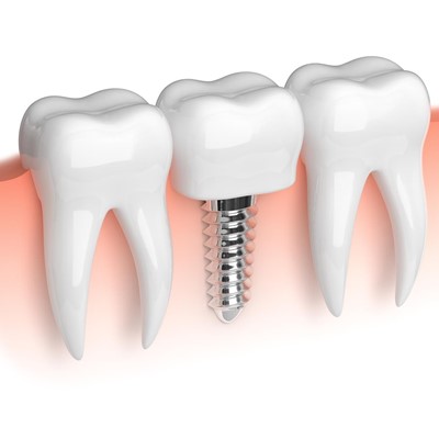 ¿Cómo calcular el precio de un implante dental?