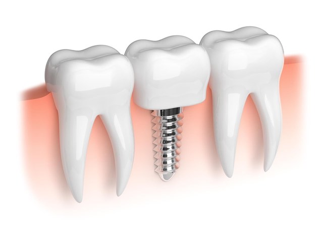 ¿Cómo calcular el precio de un implante dental?