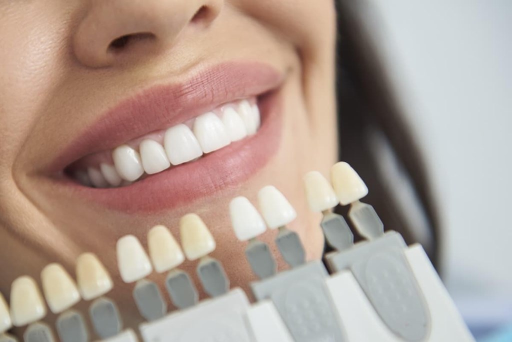 Cómo elegir las carillas dentales más adecuadas para tu caso