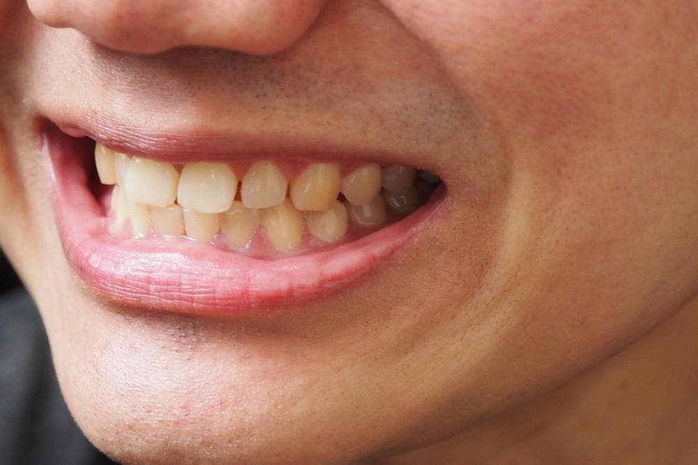 Cómo prevenir las manchas dentales y mantener una sonrisa blanca