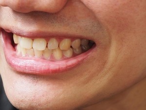 Cómo prevenir las manchas dentales y mantener una sonrisa blanca