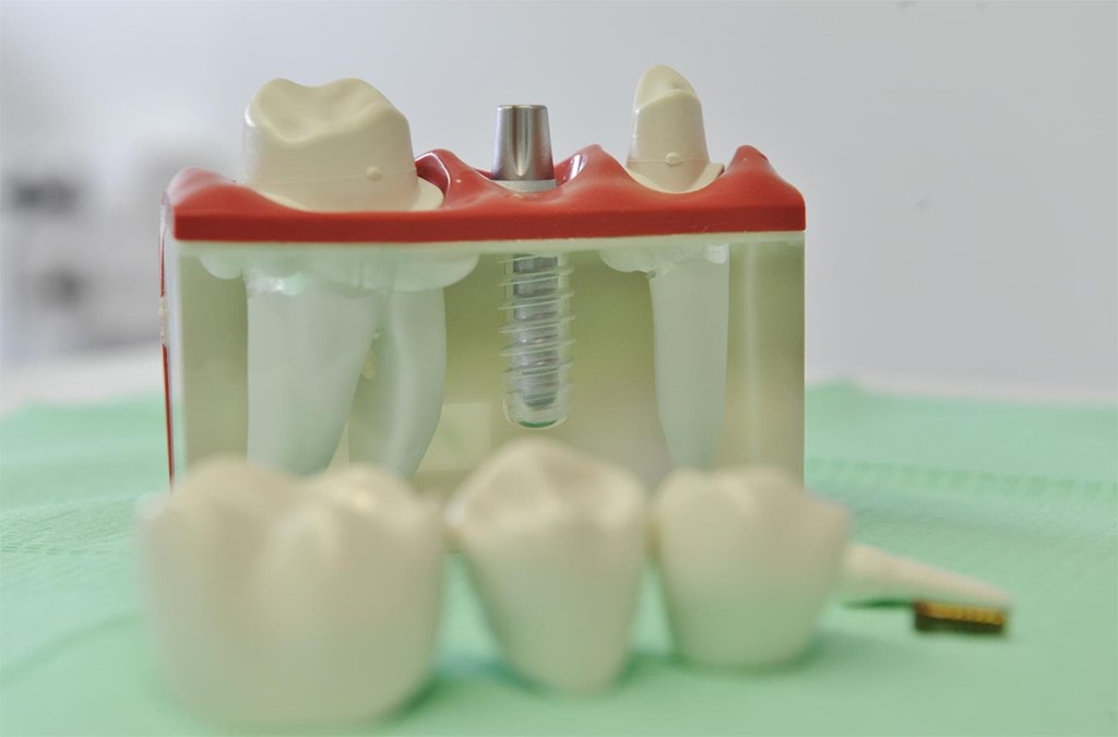 Cómo reemplazar los dientes perdidos con implantes dentales