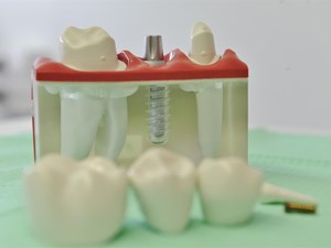 Cómo reemplazar los dientes perdidos con implantes dentales