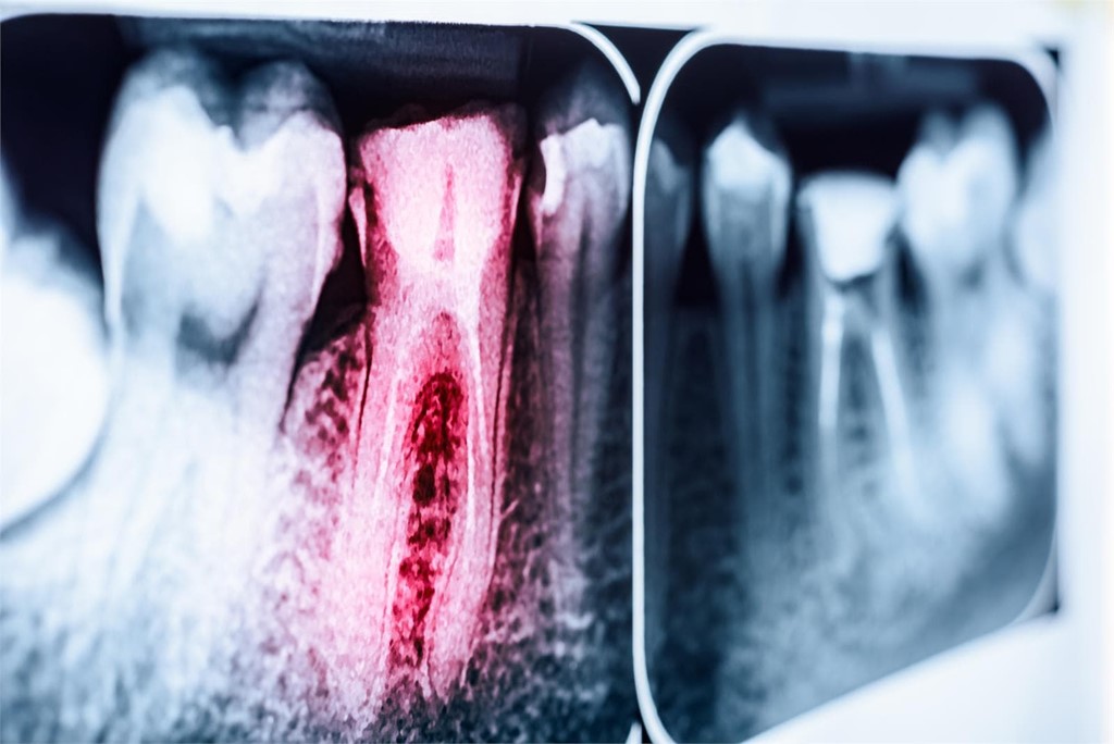 ¿Conoces los beneficios de una endodoncia?