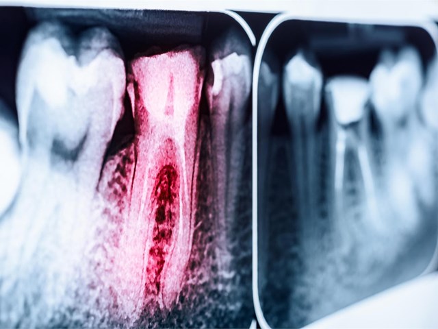¿Conoces los beneficios de una endodoncia?