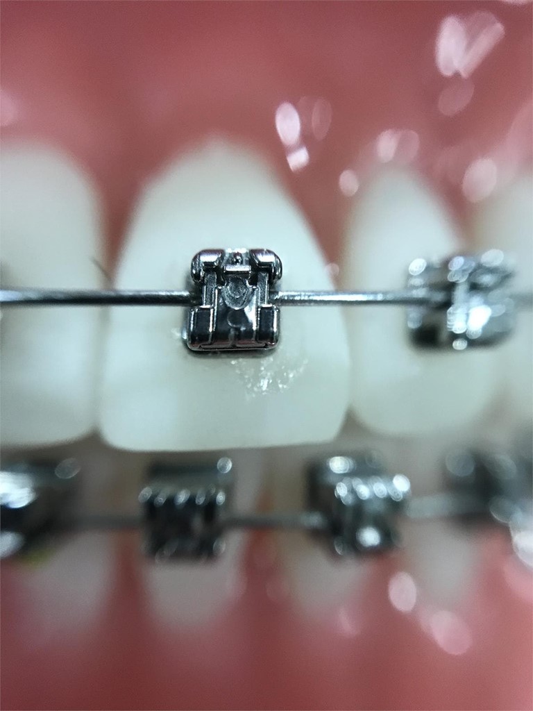 Consejos útiles sobre los brackets