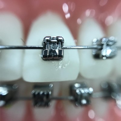 Consejos útiles sobre los brackets