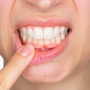 ¿Cuáles son las causas de las enfermedades de las encías?