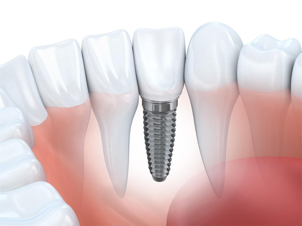 Descubre los implantes dentales