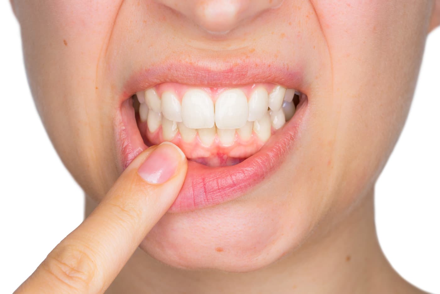 Enfermedad periodontal: ¿cuáles son sus síntomas?