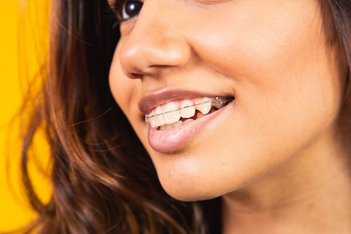 Brackets en Oleiros