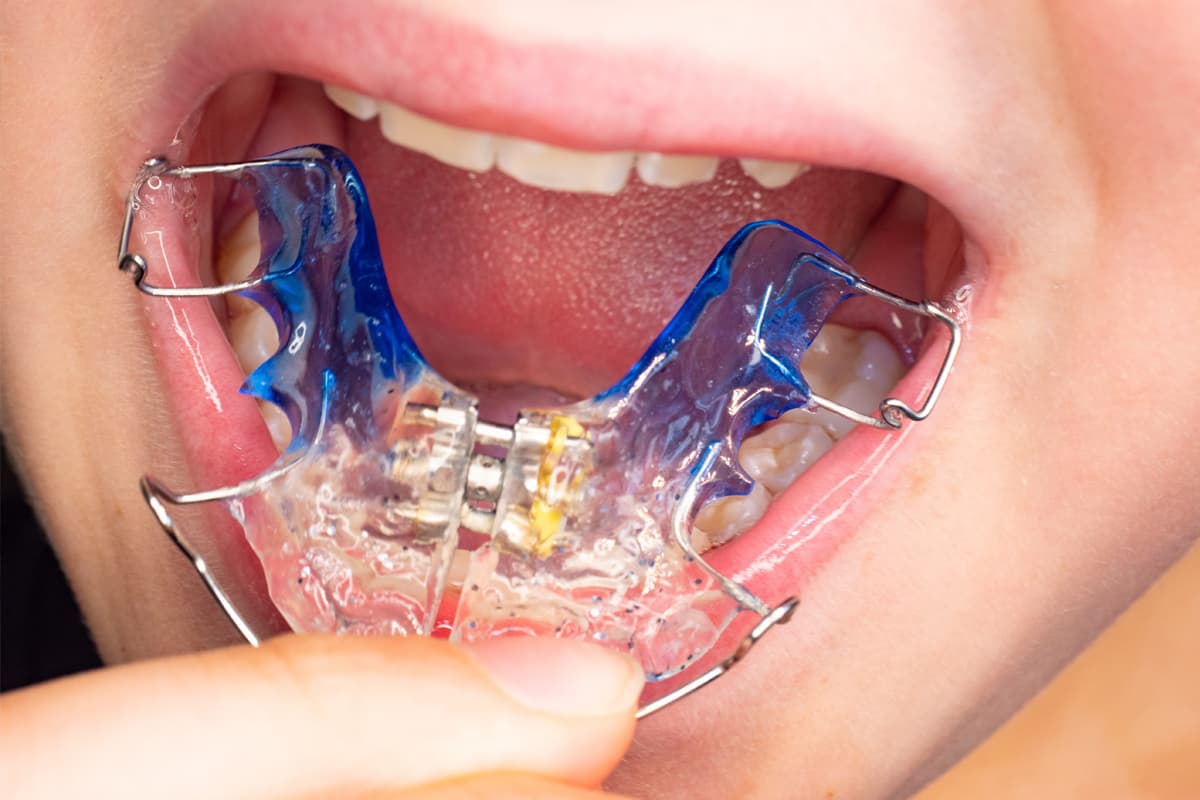 Tratamiento invisalign en Oleiros