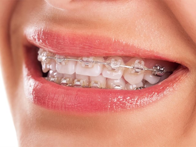 Las ventajas de los brackets