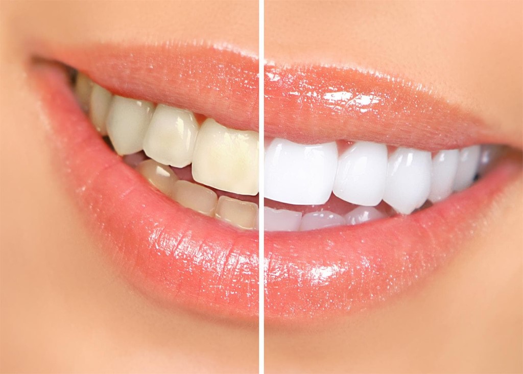Luce una sonrisa rejuvenecida este verano con el tratamiento de blanqueamiento dental