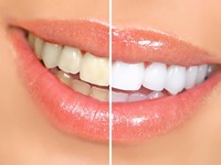 Luce una sonrisa rejuvenecida este verano con el tratamiento de blanqueamiento dental