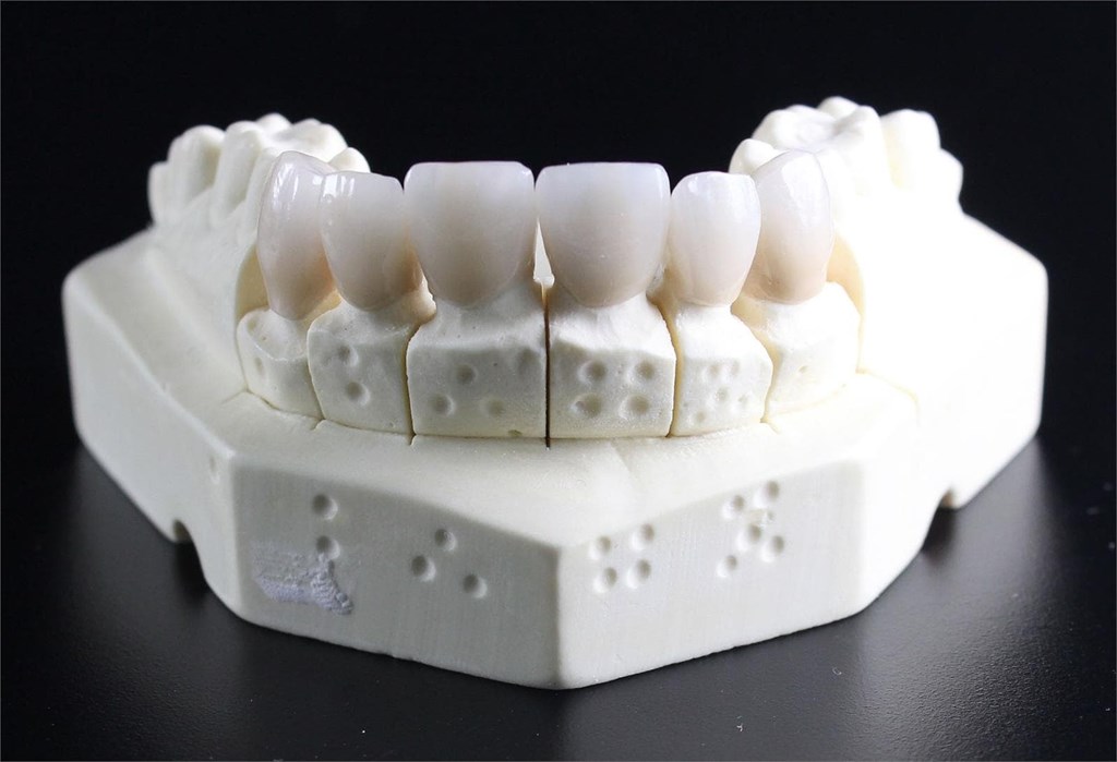 Prótesis dentales: tipos y características