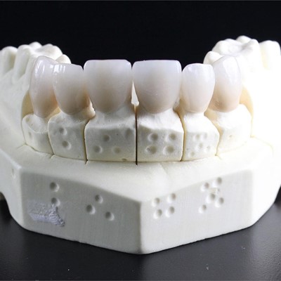 Prótesis dentales: tipos y características