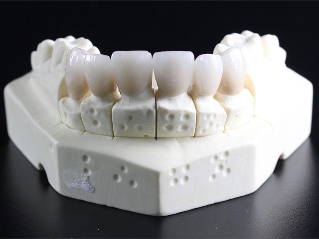 Prótesis dentales: tipos y características