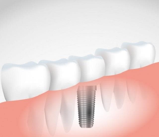 ¿Qué debes saber antes ponerte un implante dental?