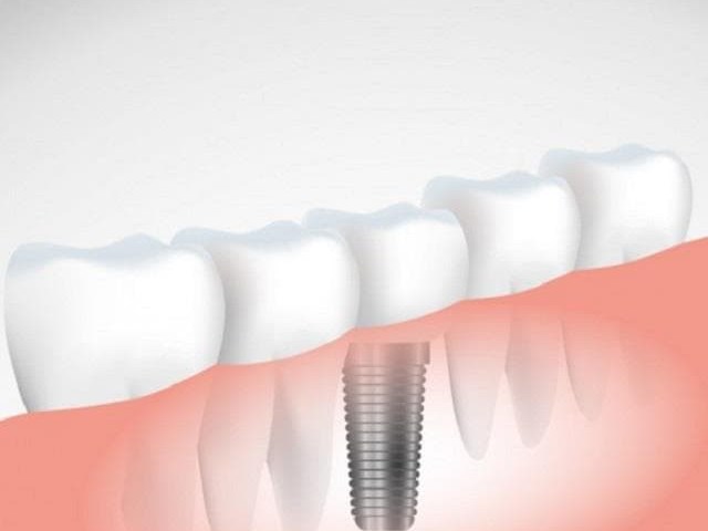 ¿Qué debes saber antes ponerte un implante dental?