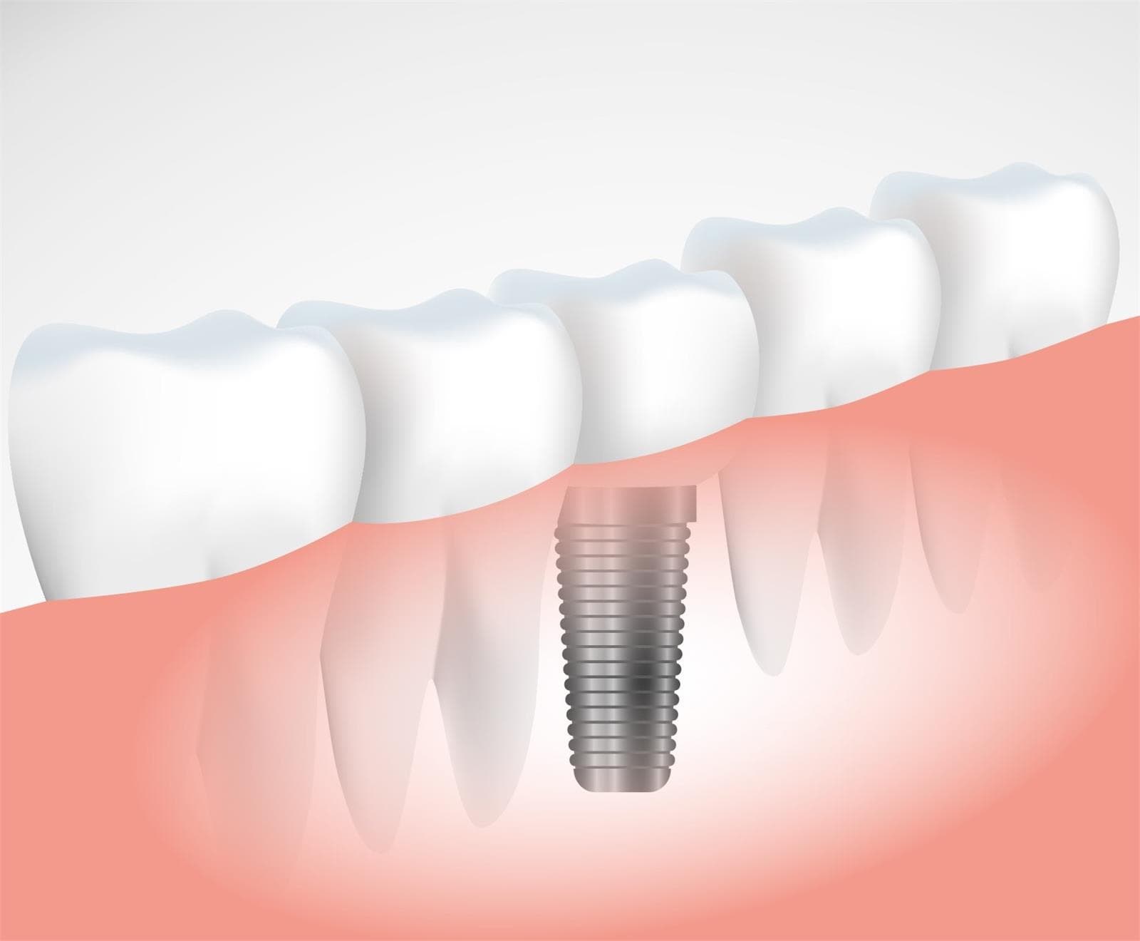 ¿Qué diferencias existen entre los implantes y las prótesis dentales? - Imagen 2