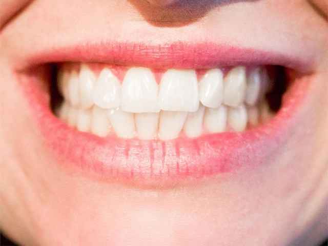 ¿Qué ofrece una restauración estética dental?