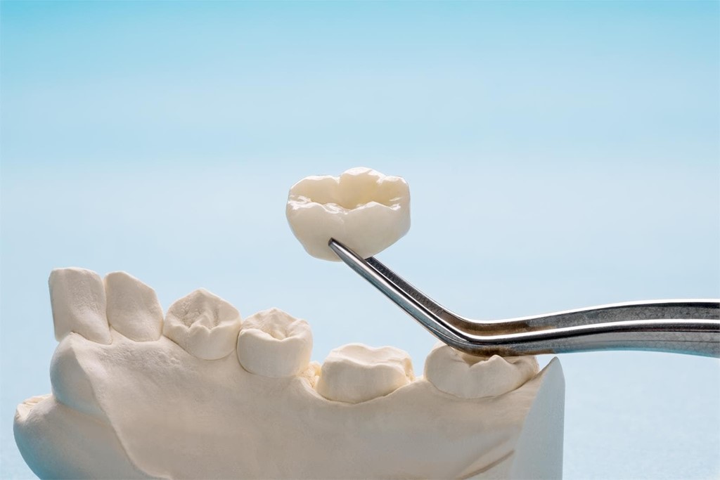 ¿Qué son las coronas dentales?