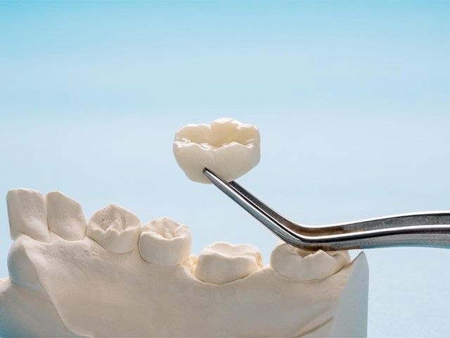 ¿Qué son las coronas dentales?