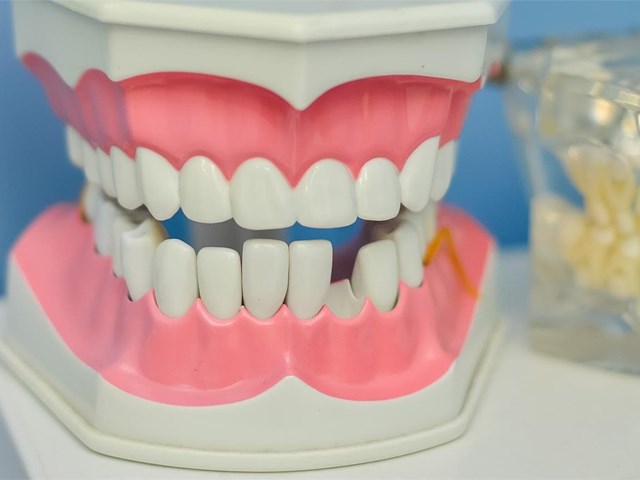 Qué tener en cuenta cuando usas prótesis dental