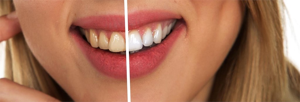 ¿Qué tener en cuenta en un blanqueamiento dental?