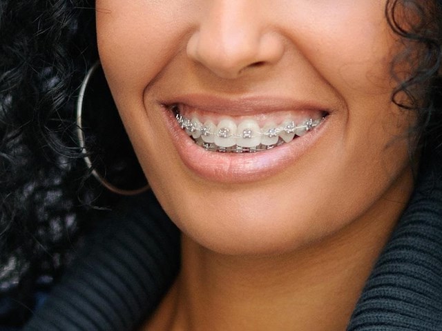 ¿Qué tipo de ortodoncias existen?