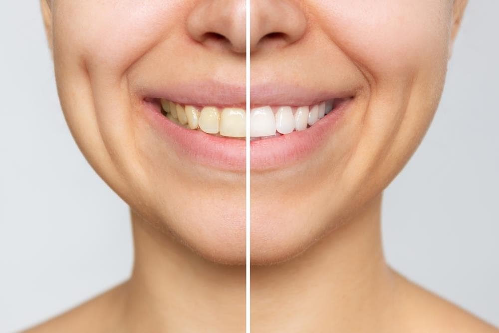 ¿Qué ventajas tiene el blanqueamiento dental profesional frente al casero?