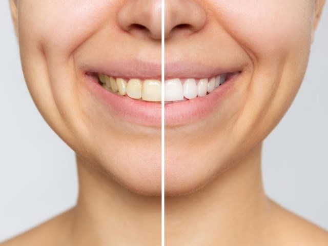 ¿Qué ventajas tiene el blanqueamiento dental profesional frente al casero?