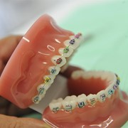 ¿Retirar los brackets de los dientes duele?