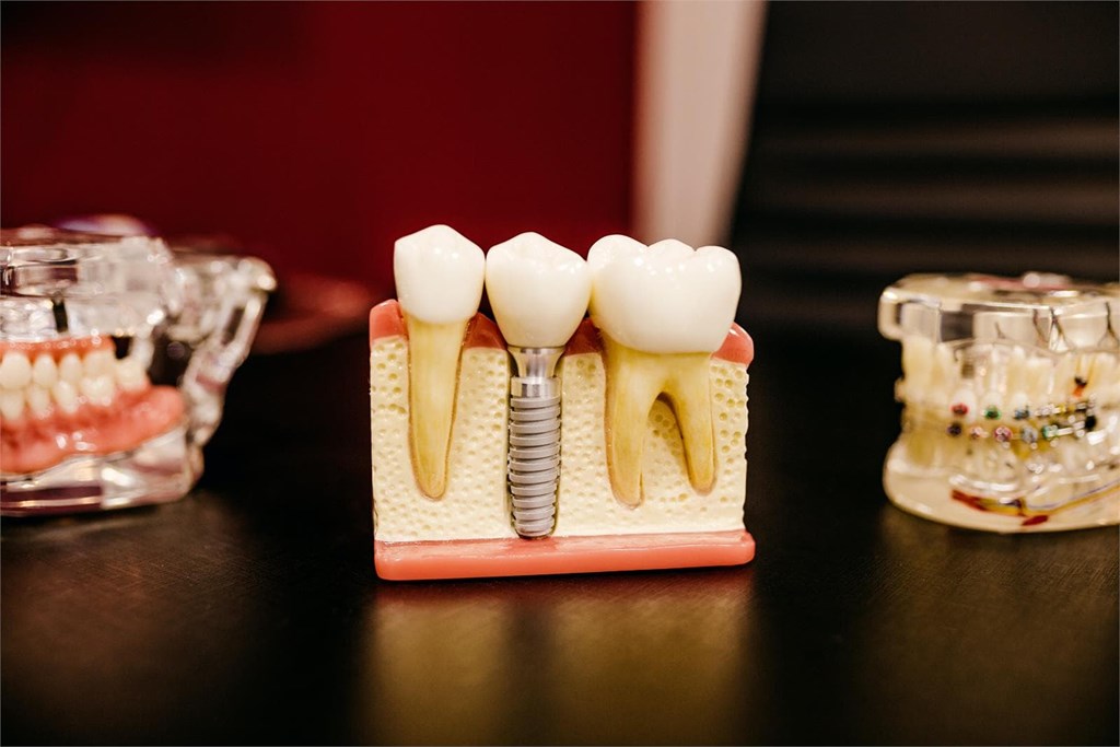 ¿Se puede hacer un implante de un solo diente?