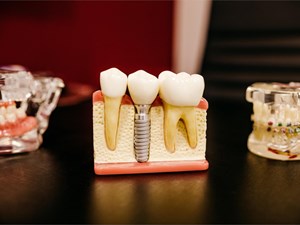 ¿Se puede hacer un implante de un solo diente?