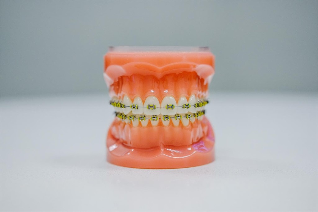 Tengo brackets... ¿hay alimentos que no puedo comer?