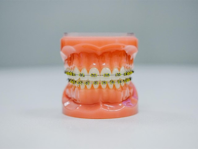 Tengo brackets... ¿hay alimentos que no puedo comer?