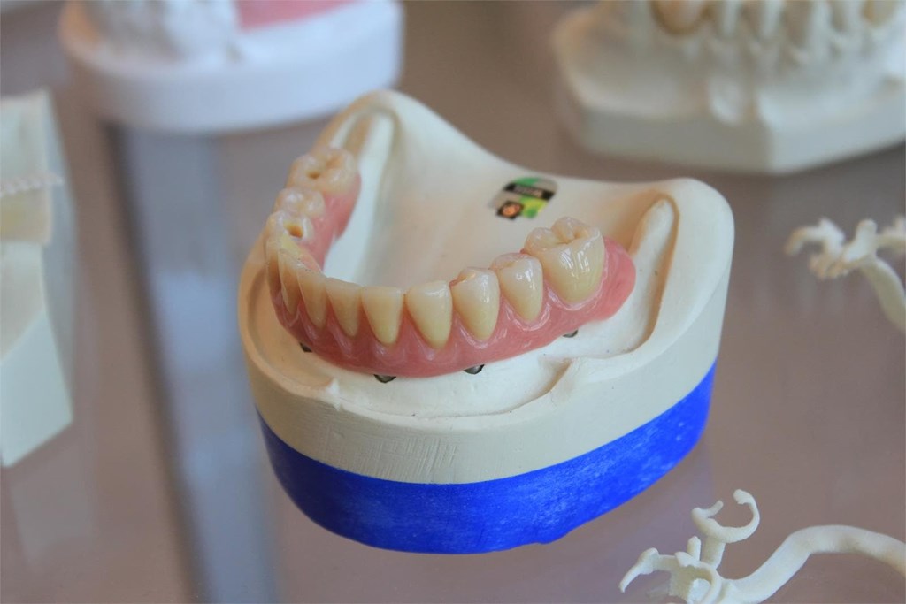 Ventajas de las prótesis dentales fijas