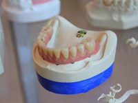 Ventajas de las prótesis dentales fijas