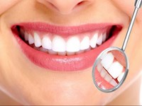 Ventajas de los tratamientos con carillas dentales